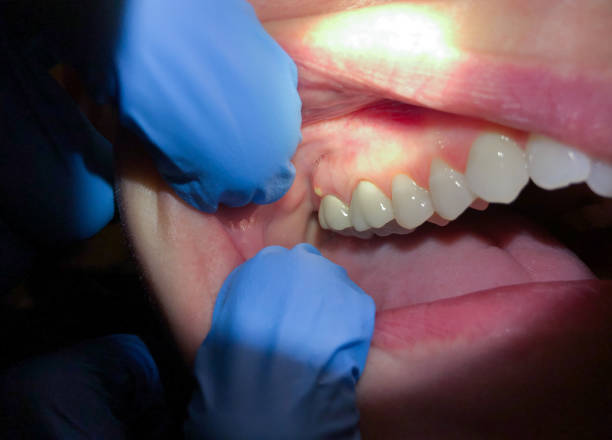 Best Dentist for Tooth Abscess  in Wales, WI